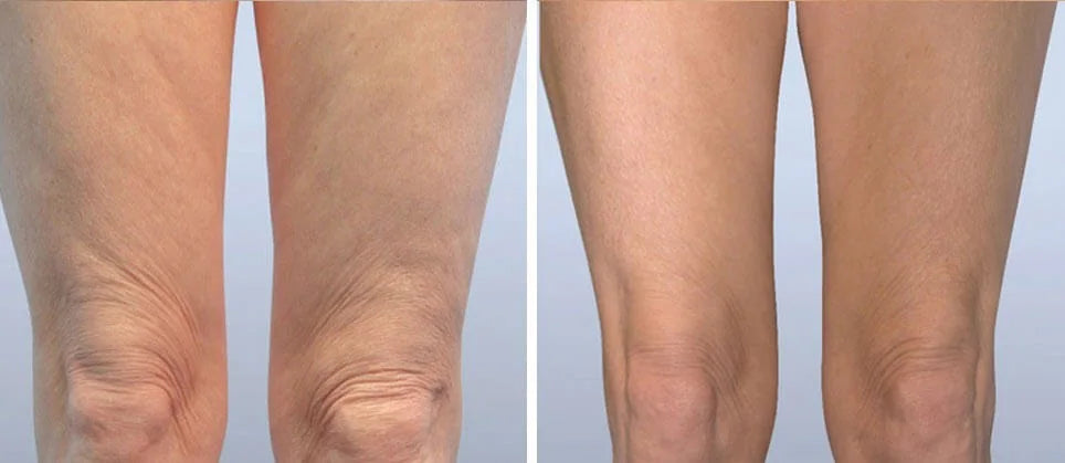 FibroFirmmmm CH