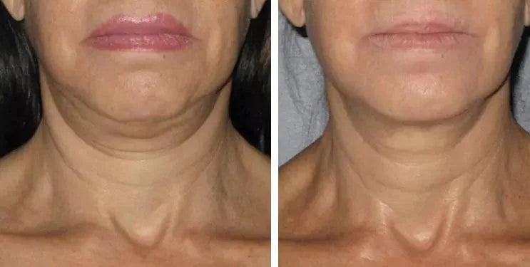 FibroFirmmmm CH