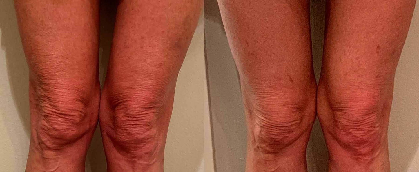 FibroFirmmmm CH