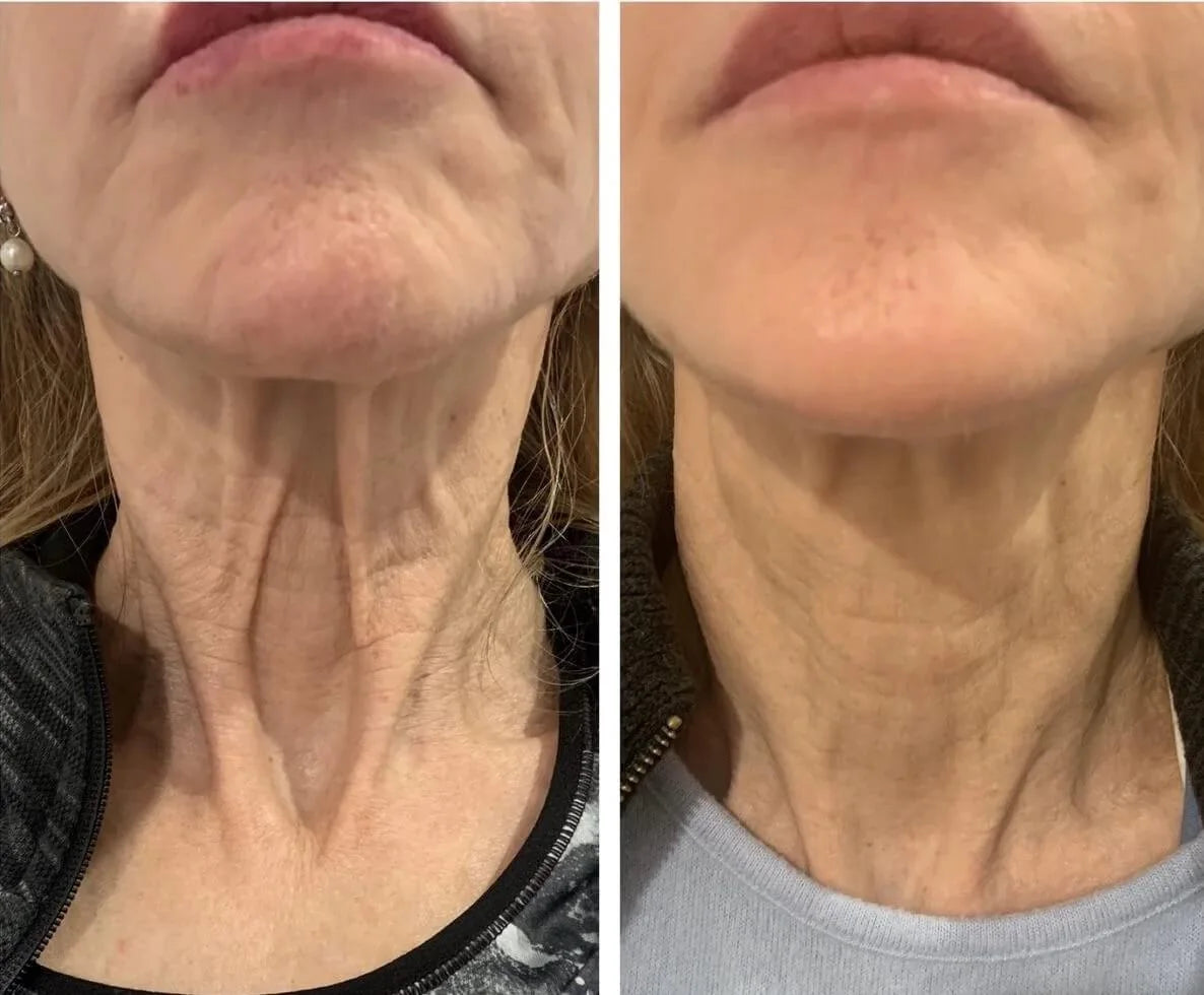 FibroFirmmmm CH