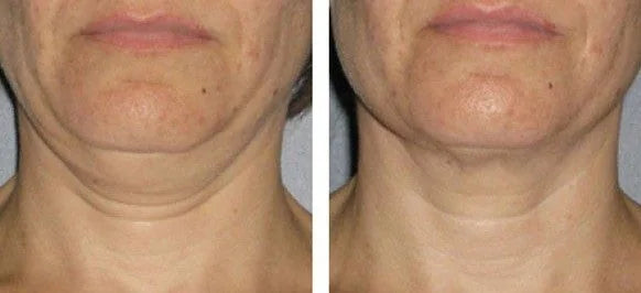 FibroFirmmmm CH