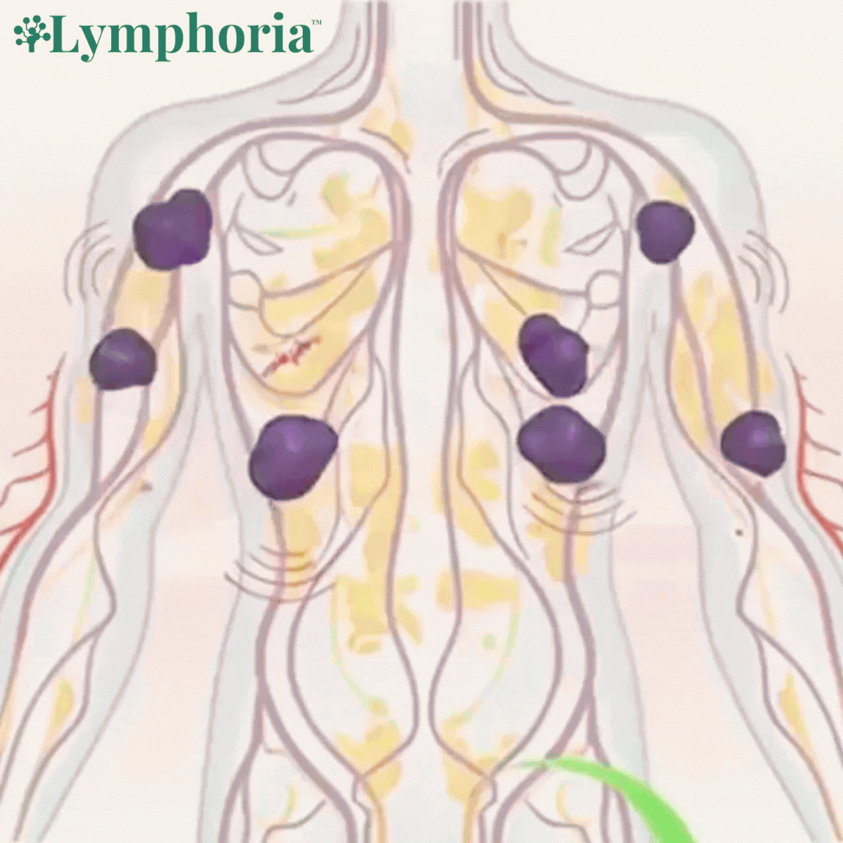Lymphoria CH