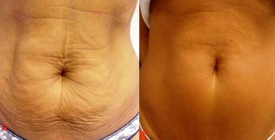 FibroFirmmmm CH