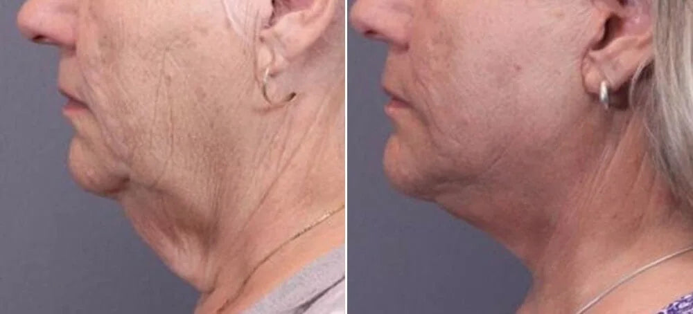 FibroFirmmmm CH